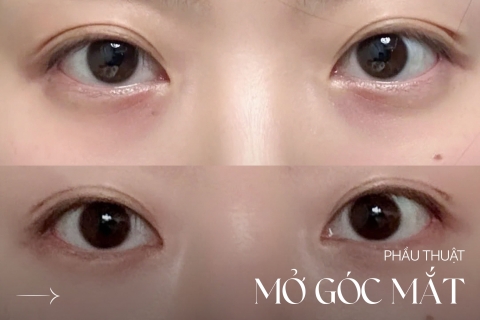 Phẫu thuật mở góc mắt